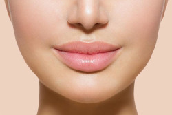 Увеличение губ с помощью гиалуроновой кислоты